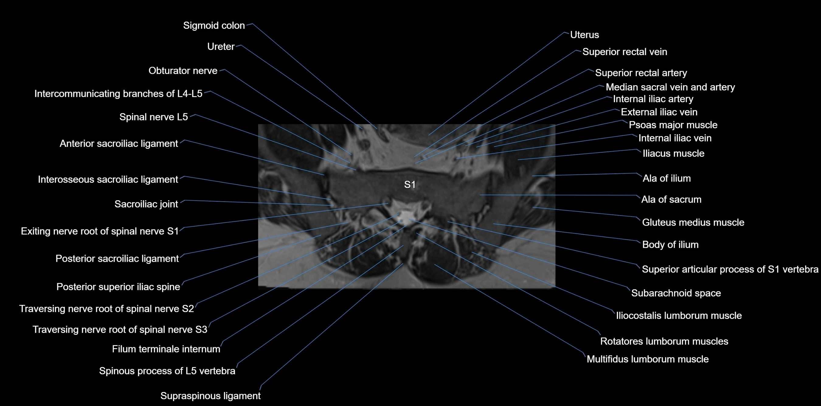 MRI sacrum, coccyx and sacroiliac joint axial cross sectional anatomy 3T  radiology  image-img-00001-00013.webp